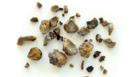 kidney stones, natural healing, avoid kidney stones