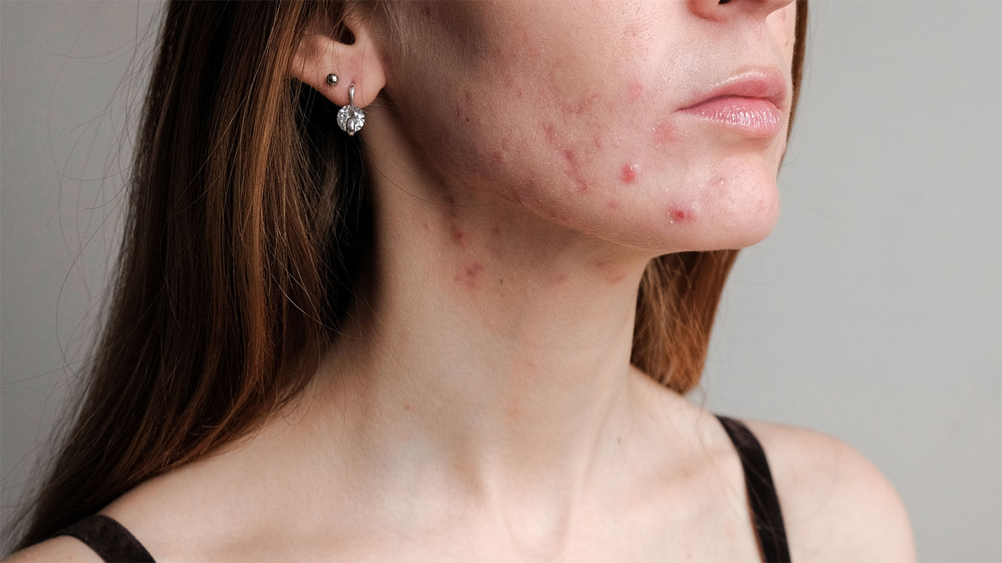 Why your treatment for hormonal acne is wrong?